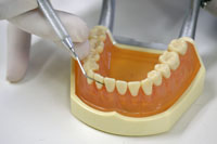 歯科衛生士の処置